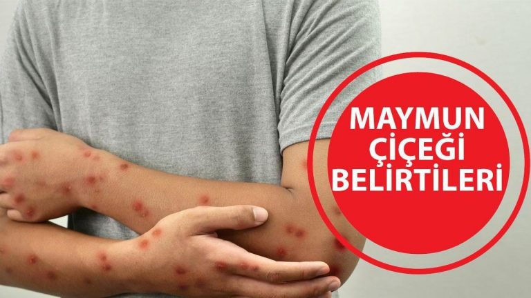 MAYMUN ÇİÇEĞİ BELİRTİLERİ: Maymun çiçeği virüsü öldürür mü? Nasıl bulaşır? Maymun çiçeği Türkiye'de görüldü mü?